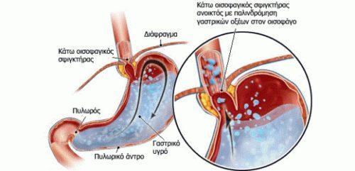 gastro-esophageal-reflux